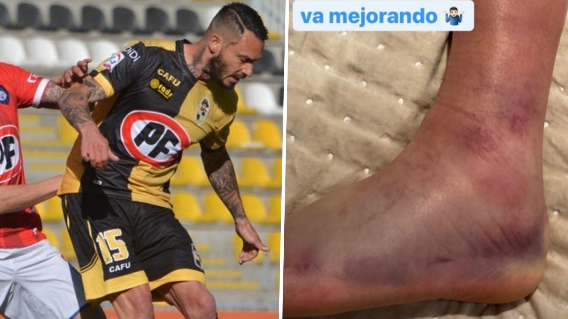 Mauricio Pinilla Coquimbo Huachipato Tobillo lesion 310820