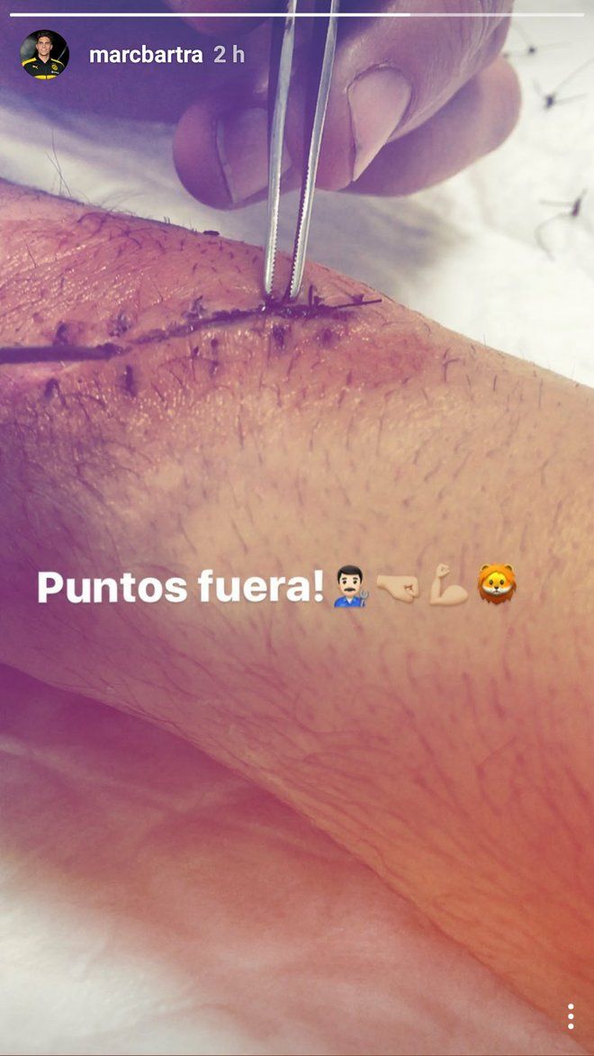 Bartra Narbe Dortmund Instagram Bundesliga
