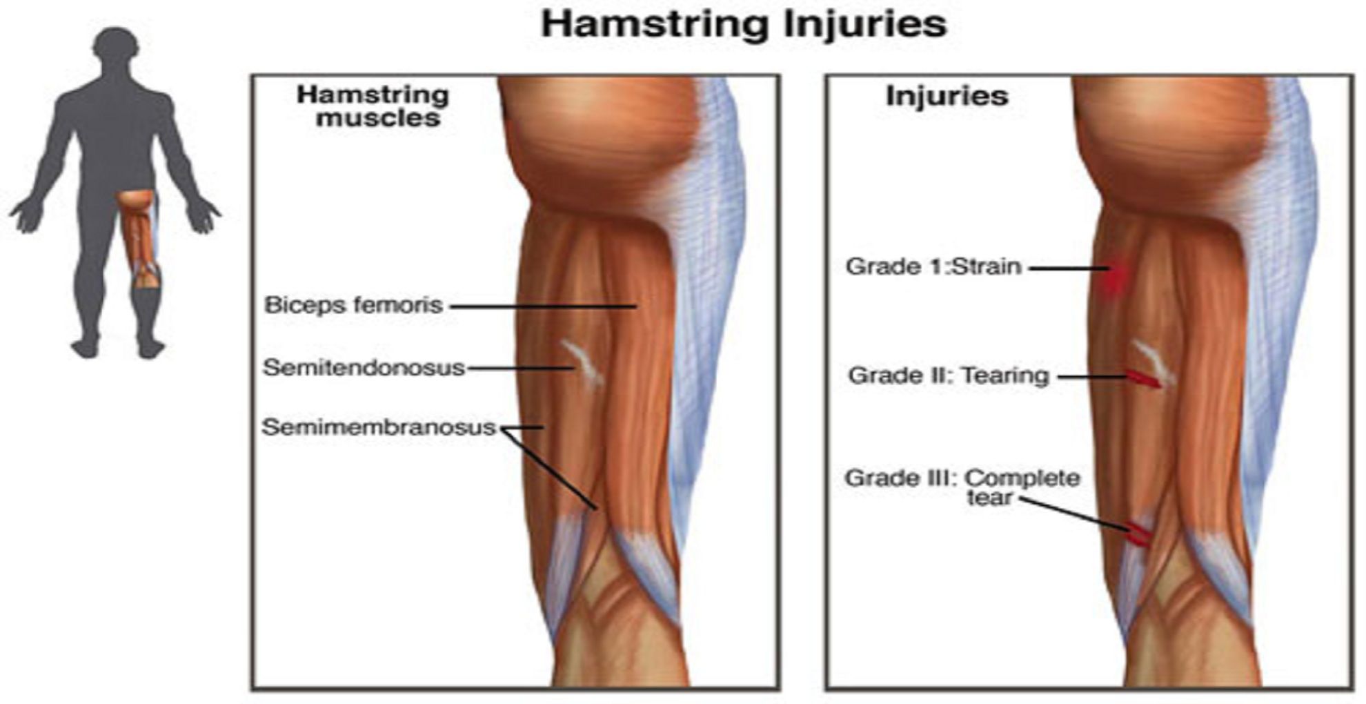 Hamstring Injuries