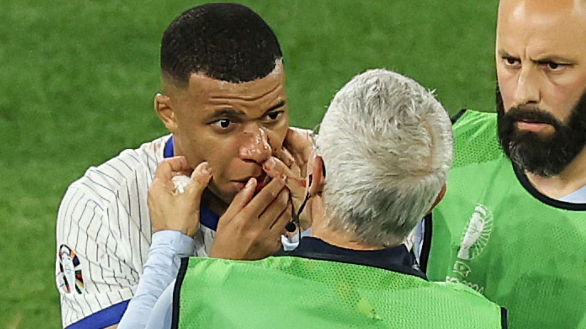 Kylian Mbappe broken nose France Euro 2024