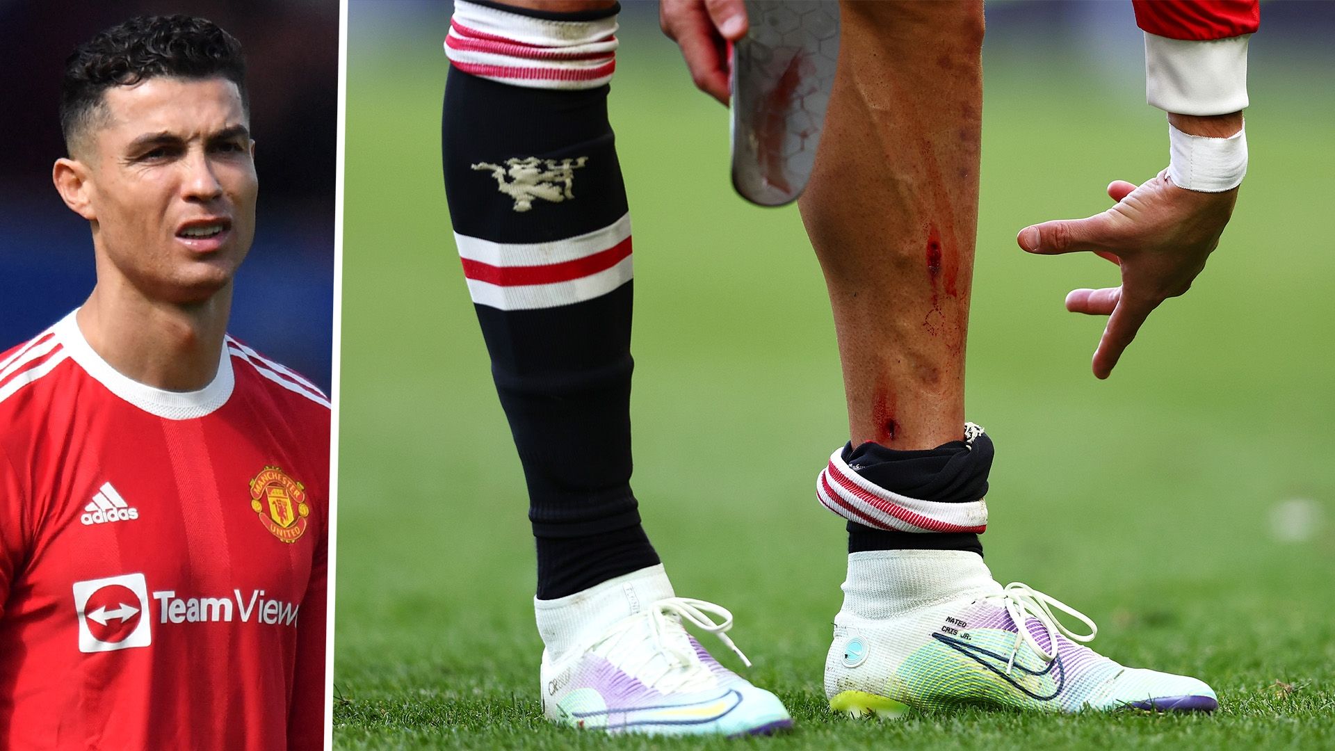 Ronaldo shows off nasty gash blood stained shin pad as he limps away after Man Utd s defeat to Everton Goal UK