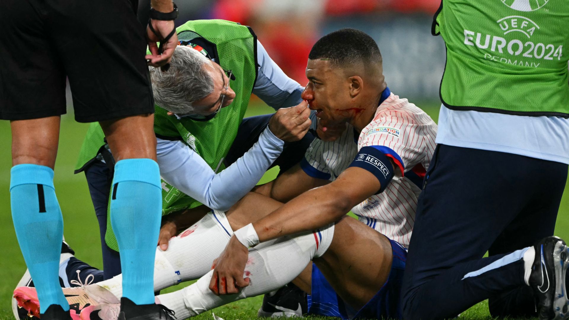 Kylian Mbappé Francia lesión Euro 2024