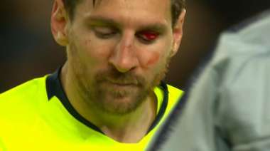 Messi Blut Auge