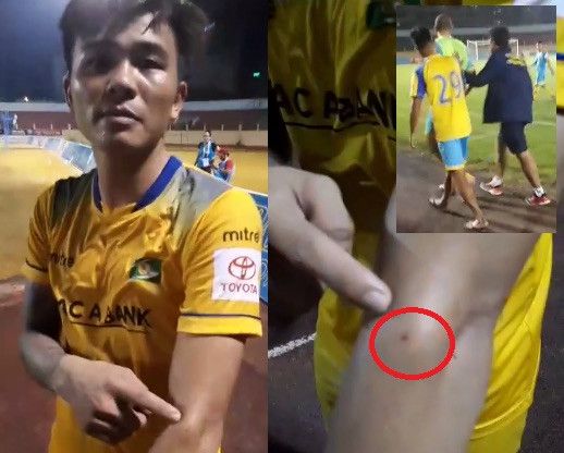 Phạm Mạnh Hùng và vết cắn