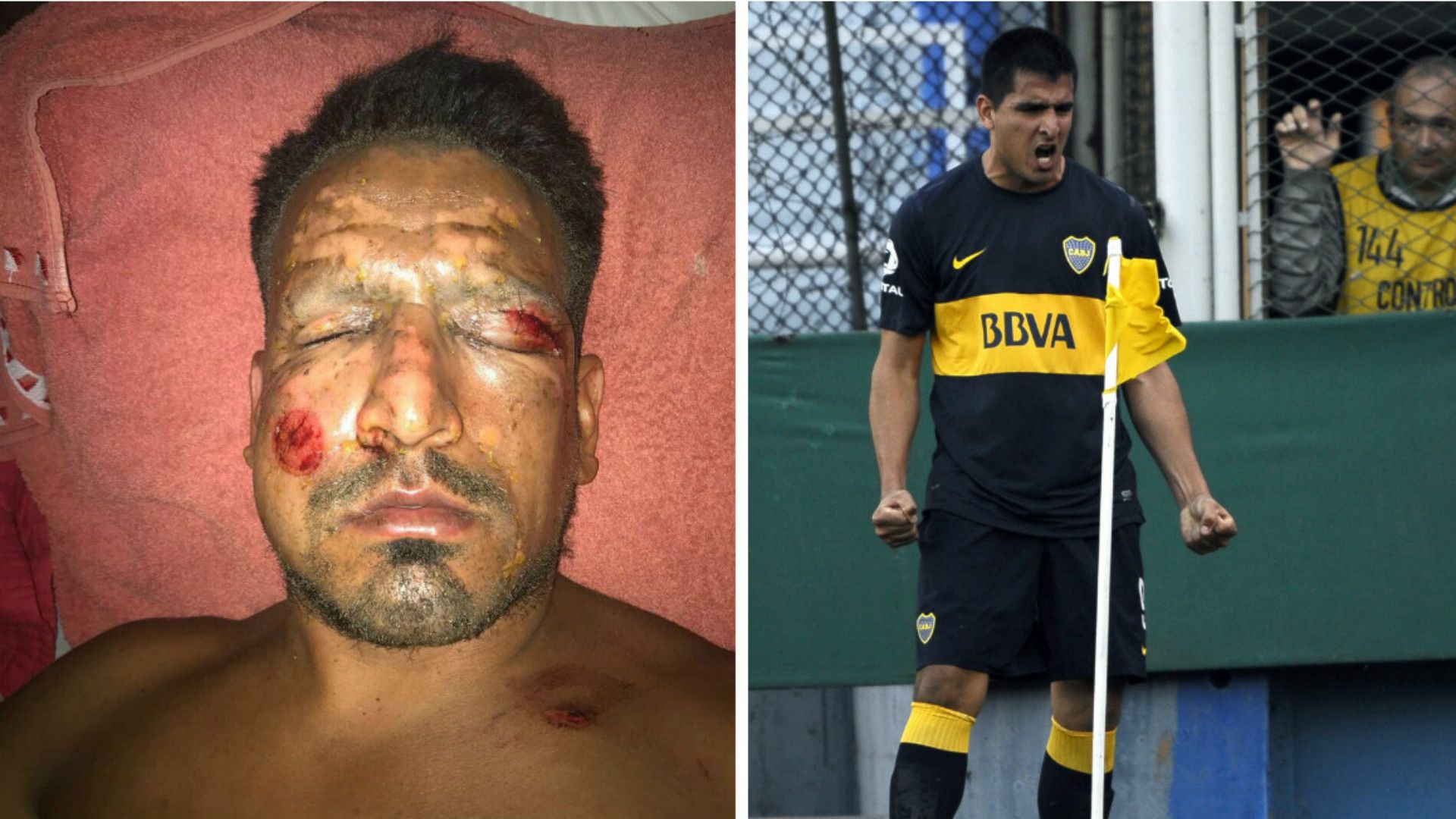 Firework injury striker