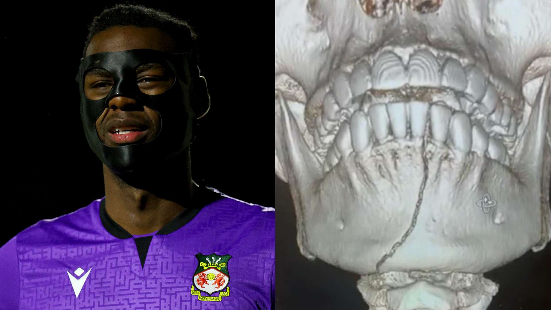 Arthur Okonkwo jaw injury
