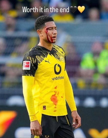 Jobe Bellingham head cut Borussia Dortmund 2025-26