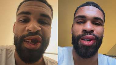 Ruben Loftus-Cheek jaw injury 2025-26