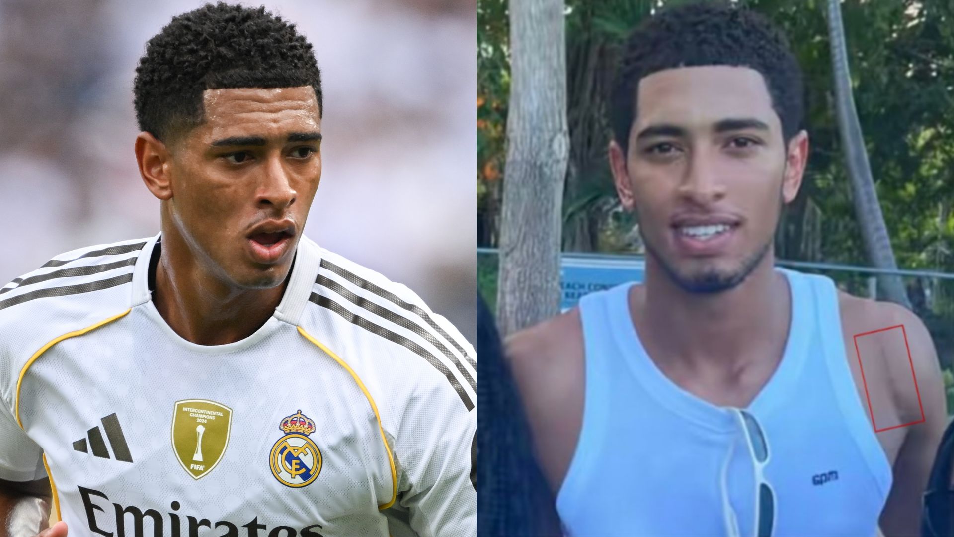 Jude Bellingham shoulder surgery scar 2025